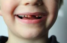 Bagaimana Hukum Menelan Darah Dari Gusi Yang Berdarah Saat Puasa